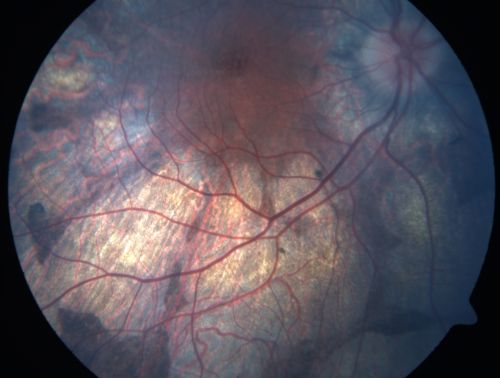 Gyrate Atrophy - 15 year old male - 20/25 vision both eyes - Positive Family History
15 year old male was diagnosed with â€œretinitis pigmentosaâ€ at age seven.  The patient reports that his night vision is poor.  He reports he does not notice a visual field change.  He reports that his maternal grandfather has lost vision and a cousin has lost vision as well.  He reports he has an uncle with some visual changes.
The most significantly affected relative is a 26-year-old legally blind cousin.
 20/25+ OD, 20/25 OS. 

