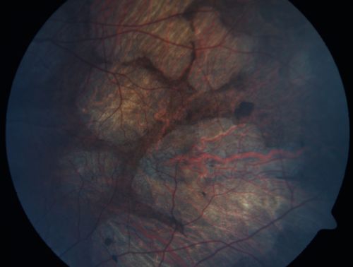 Gyrate Atrophy - 15 year old male - 20/25 vision both eyes - Positive Family History
15 year old male was diagnosed with â€œretinitis pigmentosaâ€ at age seven.  The patient reports that his night vision is poor.  He reports he does not notice a visual field change.  He reports that his maternal grandfather has lost vision and a cousin has lost vision as well.  He reports he has an uncle with some visual changes.
The most significantly affected relative is a 26-year-old legally blind cousin.
 20/25+ OD, 20/25 OS. 
