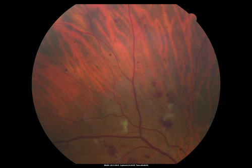 Hairy Cell Leukemia - Retinal Hemorrhage and twig Branch Vein Occlusion
79 year old man He has had hairy cell leukemia since 2002.  He is in remission.  His last blood tests were 9/2018.  He just moved down here and needs a new leukemia doctor.  His vision is fine. 
VA OD: Dcc20/25
VA OS: Dcc20/25
IOP: TP: OD:12 OS:12

