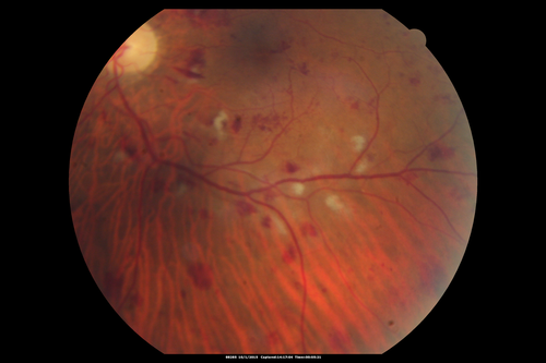Hairy Cell Leukemia - Retinal Hemorrhage and twig Branch Vein Occlusion
79 year old man He has had hairy cell leukemia since 2002.  He is in remission.  His last blood tests were 9/2018.  He just moved down here and needs a new leukemia doctor.  His vision is fine. 
VA OD: Dcc20/25
VA OS: Dcc20/25
IOP: TP: OD:12 OS:12
