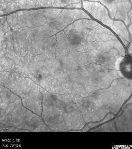 Hairy Cell Leukemia - Retinal Hemorrhage and twig Branch Vein Occlusion
79 year old man He has had hairy cell leukemia since 2002.  He is in remission.  His last blood tests were 9/2018.  He just moved down here and needs a new leukemia doctor.  His vision is fine. 
VA OD: Dcc20/25
VA OS: Dcc20/25
IOP: TP: OD:12 OS:12
