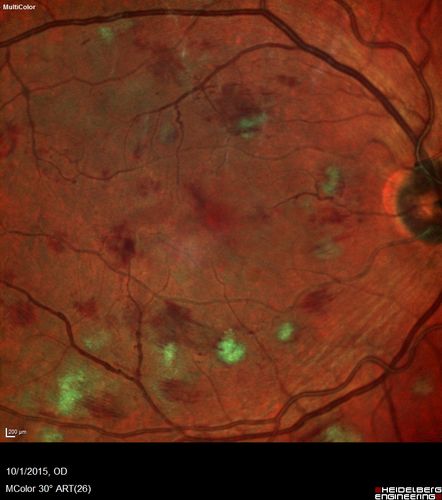 Hairy Cell Leukemia - Retinal Hemorrhage and twig Branch Vein Occlusion
79 year old man He has had hairy cell leukemia since 2002.  He is in remission.  His last blood tests were 9/2018.  He just moved down here and needs a new leukemia doctor.  His vision is fine. 
VA OD: Dcc20/25
VA OS: Dcc20/25
IOP: TP: OD:12 OS:12
