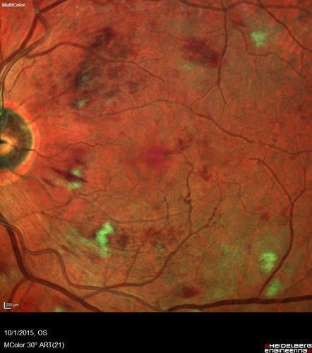 Hairy Cell Leukemia - Retinal Hemorrhage and twig Branch Vein Occlusion
79 year old man He has had hairy cell leukemia since 2002.  He is in remission.  His last blood tests were 9/2018.  He just moved down here and needs a new leukemia doctor.  His vision is fine. 
VA OD: Dcc20/25
VA OS: Dcc20/25
IOP: TP: OD:12 OS:12

