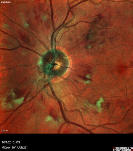 Hairy Cell Leukemia - Retinal Hemorrhage and twig Branch Vein Occlusion
79 year old man He has had hairy cell leukemia since 2002.  He is in remission.  His last blood tests were 9/2018.  He just moved down here and needs a new leukemia doctor.  His vision is fine. 
VA OD: Dcc20/25
VA OS: Dcc20/25
IOP: TP: OD:12 OS:12
