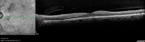 Hairy Cell Leukemia - Retinal Hemorrhage and twig Branch Vein Occlusion
79 year old man He has had hairy cell leukemia since 2002.  He is in remission.  His last blood tests were 9/2018.  He just moved down here and needs a new leukemia doctor.  His vision is fine. 
VA OD: Dcc20/25
VA OS: Dcc20/25
IOP: TP: OD:12 OS:12
