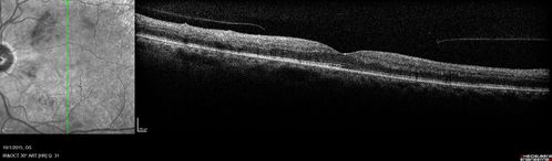 Hairy Cell Leukemia - Retinal Hemorrhage and twig Branch Vein Occlusion
79 year old man He has had hairy cell leukemia since 2002.  He is in remission.  His last blood tests were 9/2018.  He just moved down here and needs a new leukemia doctor.  His vision is fine. 
VA OD: Dcc20/25
VA OS: Dcc20/25
IOP: TP: OD:12 OS:12
