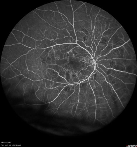 Hairy Cell Leukemia - Retinal Hemorrhage and twig Branch Vein Occlusion
79 year old man He has had hairy cell leukemia since 2002.  He is in remission.  His last blood tests were 9/2018.  He just moved down here and needs a new leukemia doctor.  His vision is fine. 
VA OD: Dcc20/25
VA OS: Dcc20/25
IOP: TP: OD:12 OS:12
