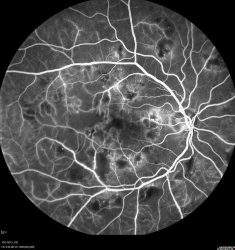 Hairy Cell Leukemia - Retinal Hemorrhage and twig Branch Vein Occlusion
79 year old man He has had hairy cell leukemia since 2002.  He is in remission.  His last blood tests were 9/2018.  He just moved down here and needs a new leukemia doctor.  His vision is fine. 
VA OD: Dcc20/25
VA OS: Dcc20/25
IOP: TP: OD:12 OS:12
