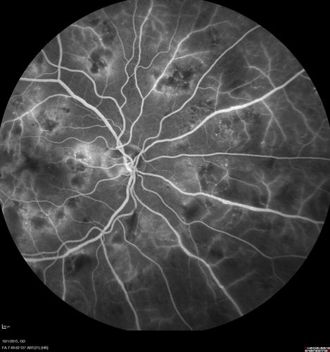 Hairy Cell Leukemia - Retinal Hemorrhage and twig Branch Vein Occlusion
79 year old man He has had hairy cell leukemia since 2002.  He is in remission.  His last blood tests were 9/2018.  He just moved down here and needs a new leukemia doctor.  His vision is fine. 
VA OD: Dcc20/25
VA OS: Dcc20/25
IOP: TP: OD:12 OS:12

