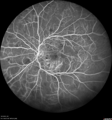 Hairy Cell Leukemia - Retinal Hemorrhage and twig Branch Vein Occlusion
79 year old man He has had hairy cell leukemia since 2002.  He is in remission.  His last blood tests were 9/2018.  He just moved down here and needs a new leukemia doctor.  His vision is fine. 
VA OD: Dcc20/25
VA OS: Dcc20/25
IOP: TP: OD:12 OS:12
