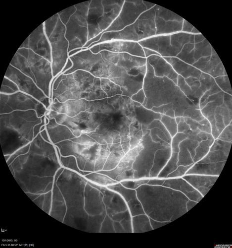 Hairy Cell Leukemia - Retinal Hemorrhage and twig Branch Vein Occlusion
79 year old man He has had hairy cell leukemia since 2002.  He is in remission.  His last blood tests were 9/2018.  He just moved down here and needs a new leukemia doctor.  His vision is fine. 
VA OD: Dcc20/25
VA OS: Dcc20/25
IOP: TP: OD:12 OS:12
