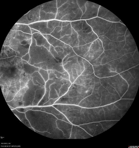 Hairy Cell Leukemia - Retinal Hemorrhage and twig Branch Vein Occlusion
79 year old man He has had hairy cell leukemia since 2002.  He is in remission.  His last blood tests were 9/2018.  He just moved down here and needs a new leukemia doctor.  His vision is fine. 
VA OD: Dcc20/25
VA OS: Dcc20/25
IOP: TP: OD:12 OS:12

