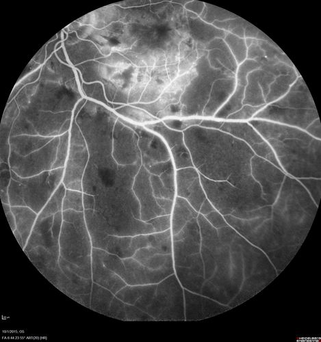 Hairy Cell Leukemia - Retinal Hemorrhage and twig Branch Vein Occlusion
79 year old man He has had hairy cell leukemia since 2002.  He is in remission.  His last blood tests were 9/2018.  He just moved down here and needs a new leukemia doctor.  His vision is fine. 
VA OD: Dcc20/25
VA OS: Dcc20/25
IOP: TP: OD:12 OS:12

