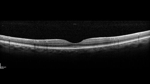 hairycellleukemia_wikre_070519_03.jpg