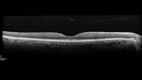 hairycellleukemia_wikre_070519_04.jpg