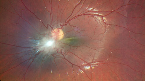 Combined hamartoma of the retina and retinal pigment epithelium
8 year old boy failed vision screening at school.  VA 20/20 OD, 20/40 OS

