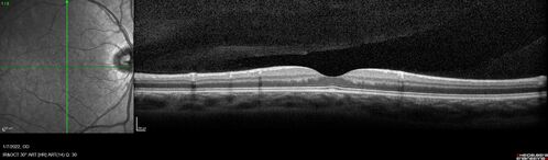 Combined hamartoma of the retina and retinal pigment epithelium
8 year old boy failed vision screening at school.  VA 20/20 OD, 20/40 OS
