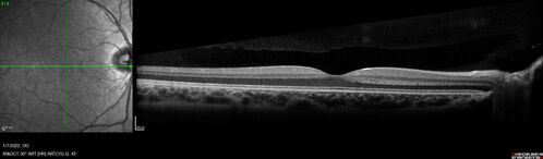 Combined hamartoma of the retina and retinal pigment epithelium
8 year old boy failed vision screening at school.  VA 20/20 OD, 20/40 OS
