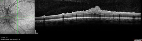 Combined hamartoma of the retina and retinal pigment epithelium
8 year old boy failed vision screening at school.  VA 20/20 OD, 20/40 OS
