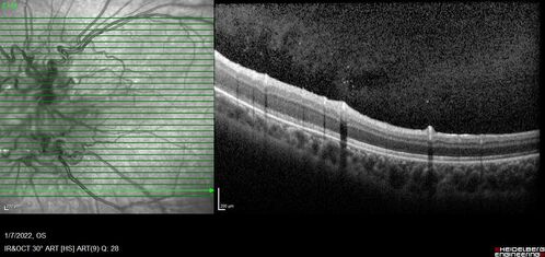 Combined hamartoma of the retina and retinal pigment epithelium
8 year old boy failed vision screening at school.  VA 20/20 OD, 20/40 OS
