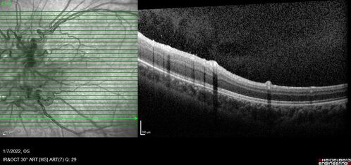 Combined hamartoma of the retina and retinal pigment epithelium
8 year old boy failed vision screening at school.  VA 20/20 OD, 20/40 OS
