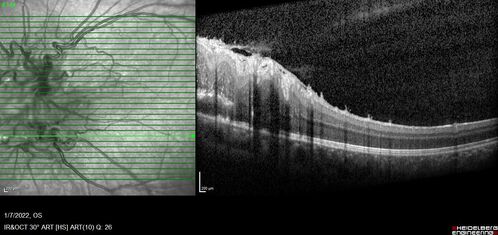 Combined hamartoma of the retina and retinal pigment epithelium
8 year old boy failed vision screening at school.  VA 20/20 OD, 20/40 OS

