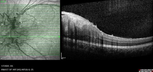 Combined hamartoma of the retina and retinal pigment epithelium
8 year old boy failed vision screening at school.  VA 20/20 OD, 20/40 OS
