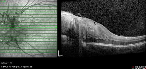 Combined hamartoma of the retina and retinal pigment epithelium
8 year old boy failed vision screening at school.  VA 20/20 OD, 20/40 OS
