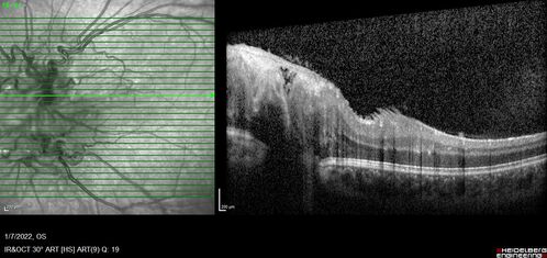 Combined hamartoma of the retina and retinal pigment epithelium
8 year old boy failed vision screening at school.  VA 20/20 OD, 20/40 OS
