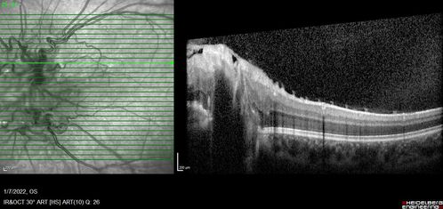 Combined hamartoma of the retina and retinal pigment epithelium
8 year old boy failed vision screening at school.  VA 20/20 OD, 20/40 OS
