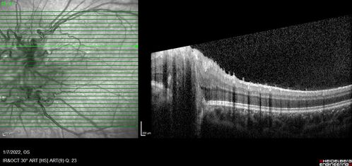 Combined hamartoma of the retina and retinal pigment epithelium
8 year old boy failed vision screening at school.  VA 20/20 OD, 20/40 OS
