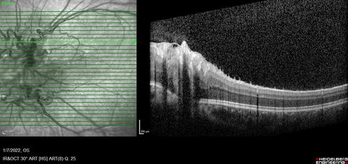 Combined hamartoma of the retina and retinal pigment epithelium
8 year old boy failed vision screening at school.  VA 20/20 OD, 20/40 OS

