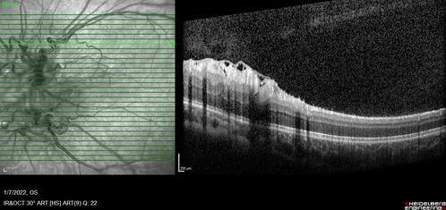 Combined hamartoma of the retina and retinal pigment epithelium
8 year old boy failed vision screening at school.  VA 20/20 OD, 20/40 OS
