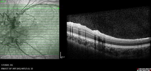 Combined hamartoma of the retina and retinal pigment epithelium
8 year old boy failed vision screening at school.  VA 20/20 OD, 20/40 OS
