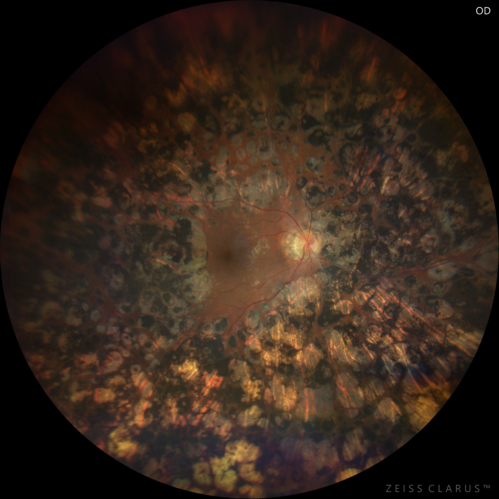 Heavy Panretinal Photocoagulation for Proliferative Diabetic Retinopathy about 40 years ago
64 year old female - images from 2018 - heavy PRP about 30 years ago 
VA 20/20 OD, 20/50 OS
