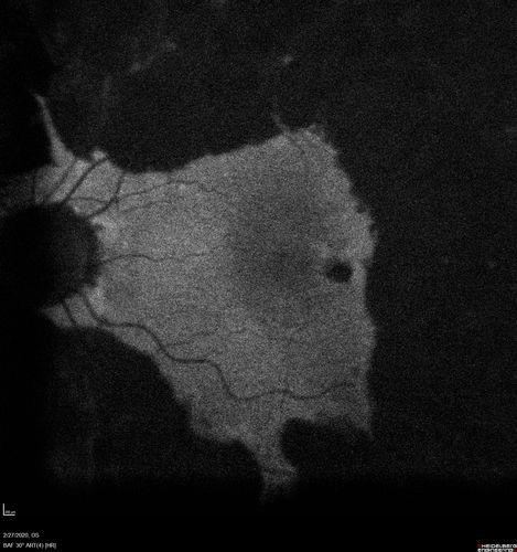 Heavy Panretinal Photocoagulation for Proliferative Diabetic Retinopathy about 40 years ago
64 year old female - images from 2018 - heavy PRP about 30 years ago 
VA 20/20 OD, 20/50 OS

