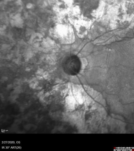 Heavy Panretinal Photocoagulation for Proliferative Diabetic Retinopathy about 40 years ago
64 year old female - images from 2018 - heavy PRP about 30 years ago 
VA 20/20 OD, 20/50 OS
