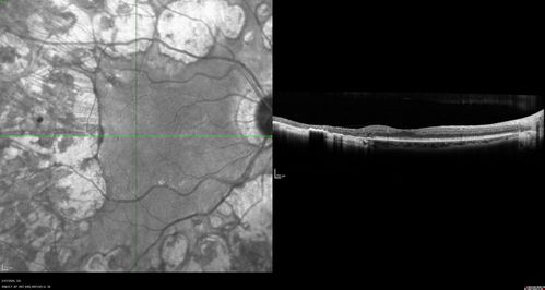 Heavy Panretinal Photocoagulation for Proliferative Diabetic Retinopathy about 40 years ago
64 year old female - images from 2018 - heavy PRP about 30 years ago 
VA 20/20 OD, 20/50 OS
