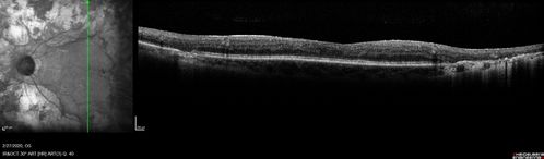 Heavy Panretinal Photocoagulation for Proliferative Diabetic Retinopathy about 40 years ago
64 year old female - images from 2018 - heavy PRP about 30 years ago 
VA 20/20 OD, 20/50 OS

