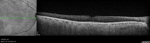 Hemangioma OS with good vison - 01-29-18
Images 7 years following initial uploaded images
