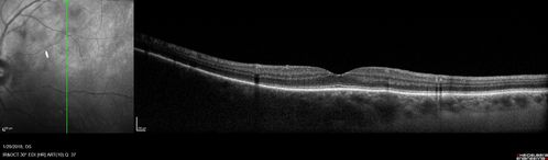 Hemangioma OS with good vison - 01-29-18
Images 7 years following initial uploaded images
