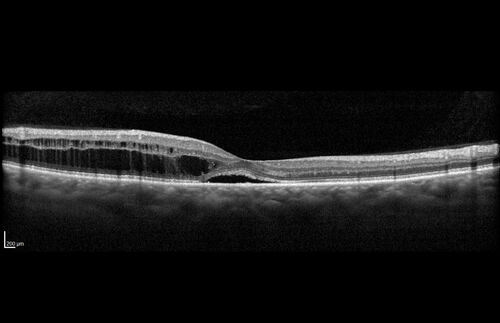 Choroidal Hemangioma Requiring PDT repeatedly
64 year old man.  Diagnosed with hemangioma in 2015.  PDT in 2016.  Images are from 2020 when fluid started to reaccumulate.  Needed PDT repeated two more times.
PDT treatments: [1] 2/19/2015 -Â  Pavan (IOPÂ  problem after PDT)Â  AND [2] 11/2/21 PDT (7 mm temporal to fovea) - SMCÂ  AND [3] 7/22/22 PDT 7.5 mm Temporal to the fovea

