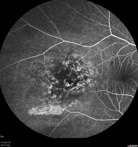Choroidal Hemangioma Requiring PDT repeatedly
64 year old man.  Diagnosed with hemangioma in 2015.  PDT in 2016.  Images are from 2020 when fluid started to reaccumulate.  Needed PDT repeated two more times.
PDT treatments: [1] 2/19/2015 -Â  Pavan (IOPÂ  problem after PDT)Â  AND [2] 11/2/21 PDT (7 mm temporal to fovea) - SMCÂ  AND [3] 7/22/22 PDT 7.5 mm Temporal to the fovea
