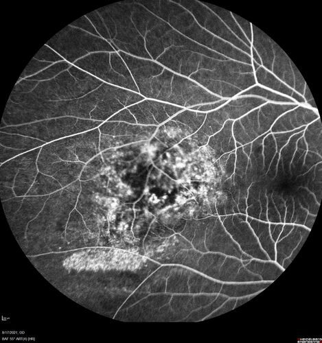 Choroidal Hemangioma Requiring PDT repeatedly
64 year old man.  Diagnosed with hemangioma in 2015.  PDT in 2016.  Images are from 2020 when fluid started to reaccumulate.  Needed PDT repeated two more times.
PDT treatments: [1] 2/19/2015 -Â  Pavan (IOPÂ  problem after PDT)Â  AND [2] 11/2/21 PDT (7 mm temporal to fovea) - SMCÂ  AND [3] 7/22/22 PDT 7.5 mm Temporal to the fovea
