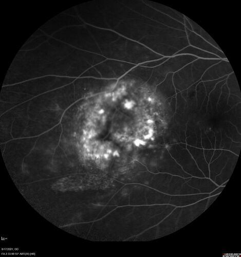 Choroidal Hemangioma Requiring PDT repeatedly
64 year old man.  Diagnosed with hemangioma in 2015.  PDT in 2016.  Images are from 2020 when fluid started to reaccumulate.  Needed PDT repeated two more times.
PDT treatments: [1] 2/19/2015 -Â  Pavan (IOPÂ  problem after PDT)Â  AND [2] 11/2/21 PDT (7 mm temporal to fovea) - SMCÂ  AND [3] 7/22/22 PDT 7.5 mm Temporal to the fovea
