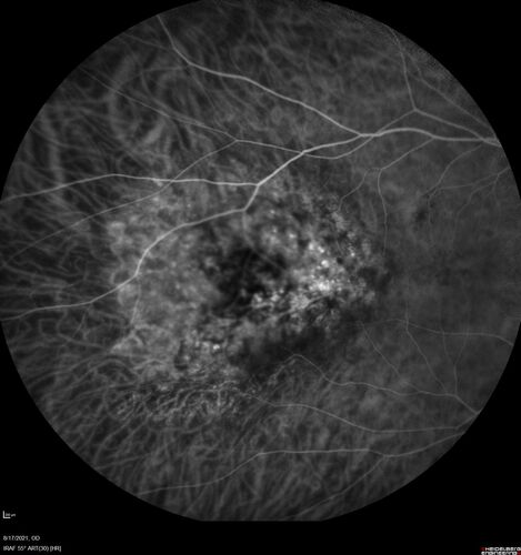 Choroidal Hemangioma Requiring PDT repeatedly
64 year old man.  Diagnosed with hemangioma in 2015.  PDT in 2016.  Images are from 2020 when fluid started to reaccumulate.  Needed PDT repeated two more times.
PDT treatments: [1] 2/19/2015 -Â  Pavan (IOPÂ  problem after PDT)Â  AND [2] 11/2/21 PDT (7 mm temporal to fovea) - SMCÂ  AND [3] 7/22/22 PDT 7.5 mm Temporal to the fovea
