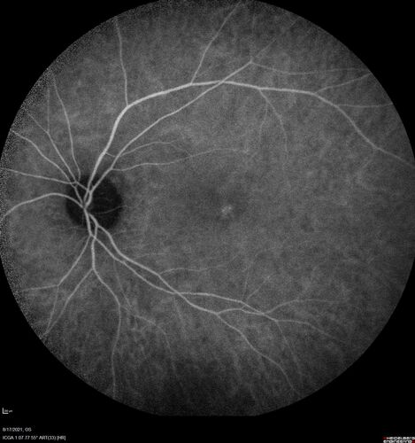 Choroidal Hemangioma Requiring PDT repeatedly
64 year old man.  Diagnosed with hemangioma in 2015.  PDT in 2016.  Images are from 2020 when fluid started to reaccumulate.  Needed PDT repeated two more times.
PDT treatments: [1] 2/19/2015 -Â  Pavan (IOPÂ  problem after PDT)Â  AND [2] 11/2/21 PDT (7 mm temporal to fovea) - SMCÂ  AND [3] 7/22/22 PDT 7.5 mm Temporal to the fovea
