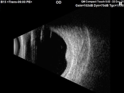 Choroidal Hemangioma Requiring PDT repeatedly
64 year old man.  Diagnosed with hemangioma in 2015.  PDT in 2016.  Images are from 2020 when fluid started to reaccumulate.  Needed PDT repeated two more times.
PDT treatments: [1] 2/19/2015 -Â  Pavan (IOPÂ  problem after PDT)Â  AND [2] 11/2/21 PDT (7 mm temporal to fovea) - SMCÂ  AND [3] 7/22/22 PDT 7.5 mm Temporal to the fovea

