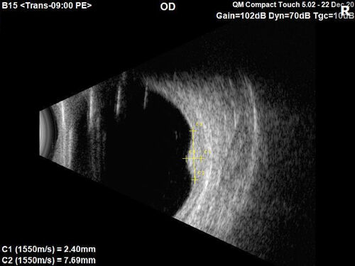 Choroidal Hemangioma Requiring PDT repeatedly
64 year old man.  Diagnosed with hemangioma in 2015.  PDT in 2016.  Images are from 2020 when fluid started to reaccumulate.  Needed PDT repeated two more times.
PDT treatments: [1] 2/19/2015 -Â  Pavan (IOPÂ  problem after PDT)Â  AND [2] 11/2/21 PDT (7 mm temporal to fovea) - SMCÂ  AND [3] 7/22/22 PDT 7.5 mm Temporal to the fovea

