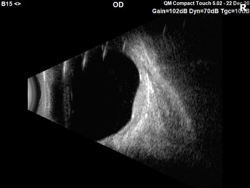 Choroidal Hemangioma Requiring PDT repeatedly
64 year old man.  Diagnosed with hemangioma in 2015.  PDT in 2016.  Images are from 2020 when fluid started to reaccumulate.  Needed PDT repeated two more times.
PDT treatments: [1] 2/19/2015 -Â  Pavan (IOPÂ  problem after PDT)Â  AND [2] 11/2/21 PDT (7 mm temporal to fovea) - SMCÂ  AND [3] 7/22/22 PDT 7.5 mm Temporal to the fovea
